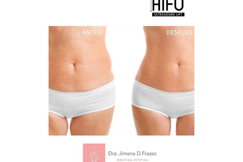 Mesoterapia antes y después - 632507