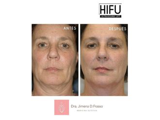 Rejuvenecimiento facial - 632508