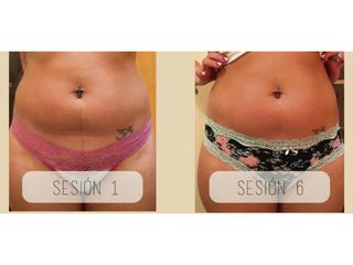 Mesoterapia