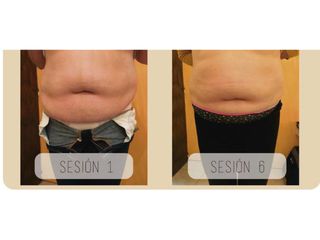 Mesoterapia