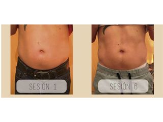 Mesoterapia