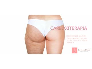 carboxiterapia