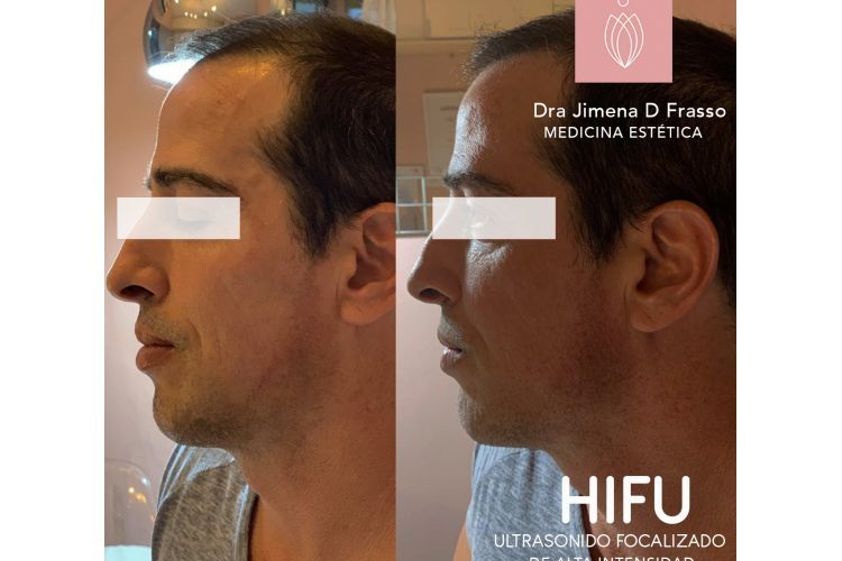HIFU antes y después - 645925