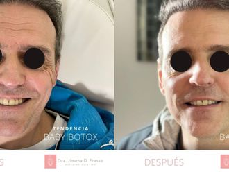 Rejuvenecimiento facial antes y después - 809171