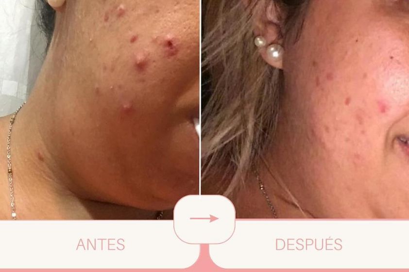 Tratamiento acné antes y después - 852645
