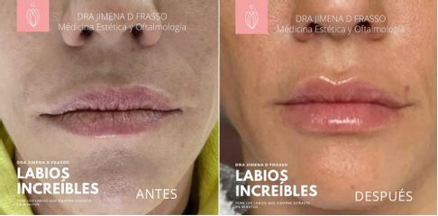 Relleno de labios - Dra. Jimena D. Frasso