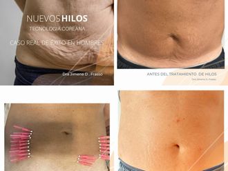 Hilos tensores antes y después - 862176