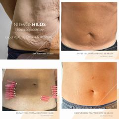 Hilos tensores - Dra. Jimena D. Frasso
