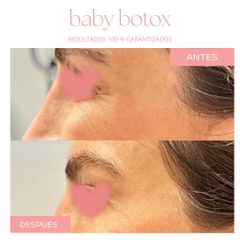 Botox - Dra. Jimena D. Frasso