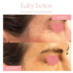 Botox - Dra. Jimena D. Frasso