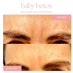 Botox - Dra. Jimena D. Frasso