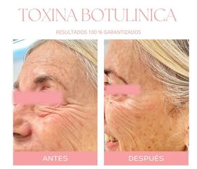 Botox - Dra. Jimena Frasso