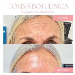 Botox - Dra. Jimena Frasso