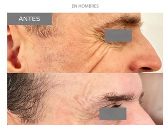 Botox antes y después - 868906