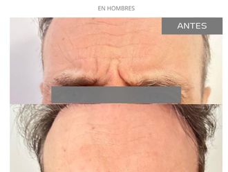 Botox antes y después - 868907