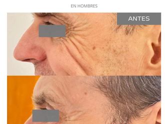 Botox antes y después - 868908