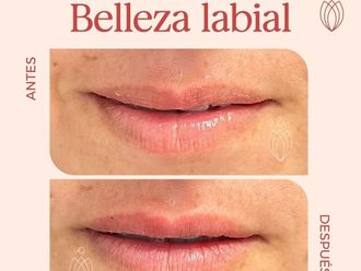 Relleno de labios antes y después - 872214