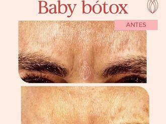 Botox antes y después - 872215