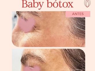 Botox antes y después - 872216