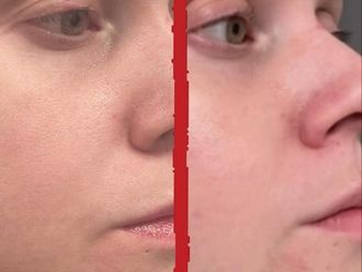 Rejuvenecimiento facial antes y después - 876156
