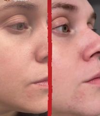 Rejuvenecimiento Facial - Dra. Jimena D. Frasso
