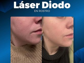 Rejuvenecimiento facial antes y después - 876942