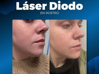 Rejuvenecimiento facial antes y después - 876943