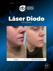 Láser Diodo en Rostro - Dra. Jessica Frasso