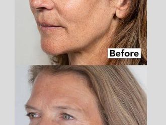 Rejuvenecimiento facial antes y después - 878612