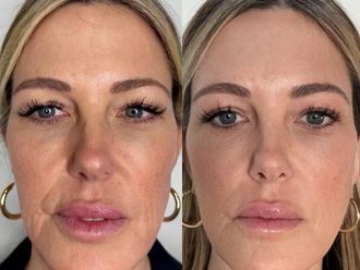 Rejuvenecimiento facial antes y después - 878613