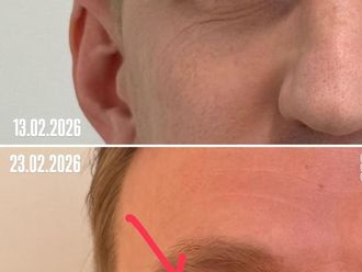 Blefaroplastia sin cirugía antes y después - 878614