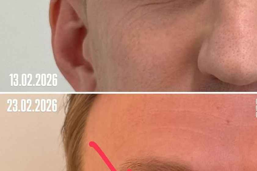 Blefaroplastia sin cirugía antes y después - 878614