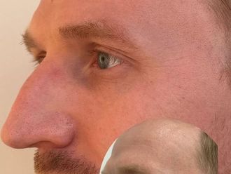 Rejuvenecimiento facial antes y después - 878615