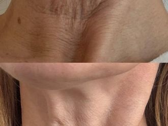 Rejuvenecimiento facial antes y después - 878616