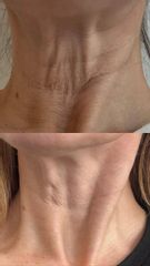 Rejuvenecimiento de Cuello - Dra. Jimena D. Frasso