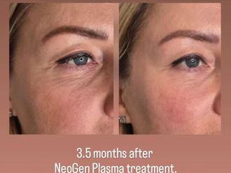 Rejuvenecimiento facial antes y después - 878626