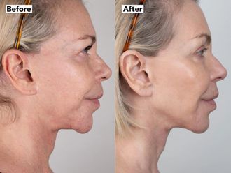 Rejuvenecimiento facial antes y después - 878629