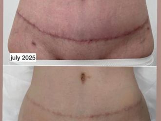 Eliminar cicatrices antes y después - 878764