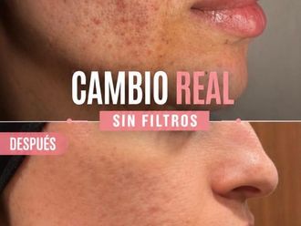 Eliminar cicatrices antes y después - 879398
