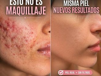 Tratamiento acné antes y después - 879399