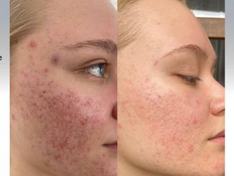 Tratamiento acné antes y después - 879403