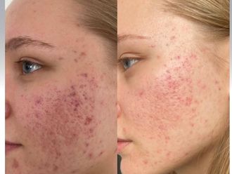 Tratamiento acné antes y después - 879404