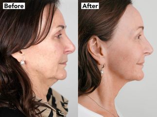 Rejuvenecimiento Facial