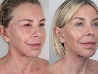 Rejuvenecimiento facial antes y después - 879437