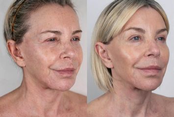 Rejuvenecimiento facial