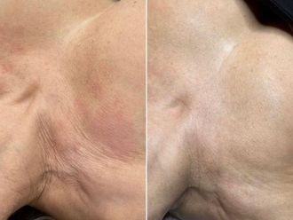 Rejuvenecimiento facial antes y después - 879438