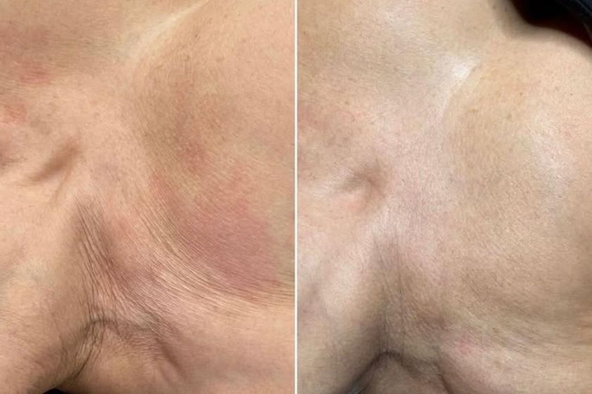 Rejuvenecimiento facial antes y después - 879438