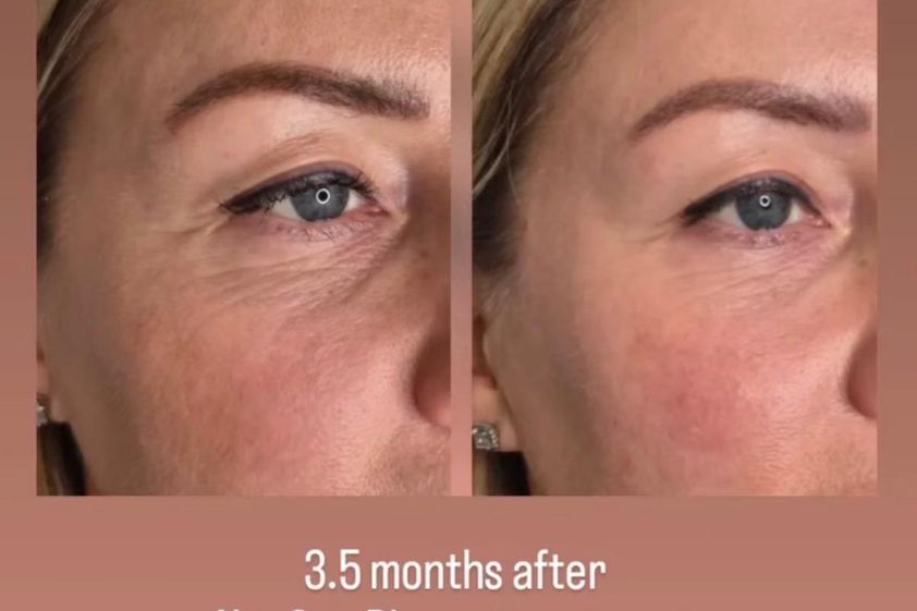Plasma Rico en Plaquetas antes y después - 879439