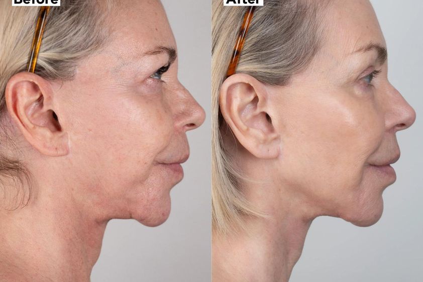 Rejuvenecimiento facial antes y después - 879441