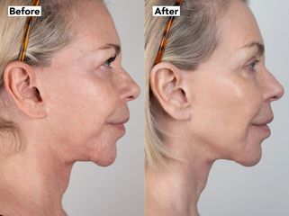 Rejuvenecimiento facial